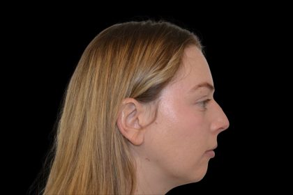 Rhinoplasty Before & After Patient #19537