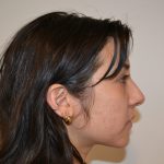 Rhinoplasty Before & After Patient #19536