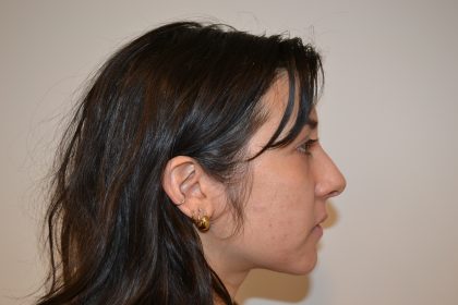 Rhinoplasty Before & After Patient #19536