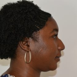Rhinoplasty Before & After Patient #19557
