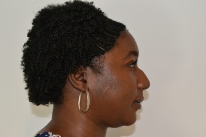 Rhinoplasty Before & After Patient #19557