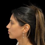 Rhinoplasty Before & After Patient #19535