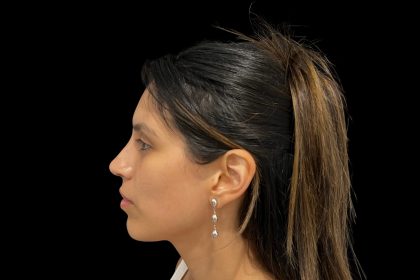 Rhinoplasty Before & After Patient #19535