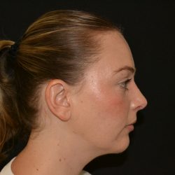 Rhinoplasty Before & After Patient #19537