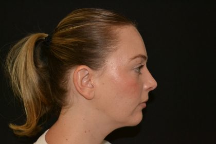 Rhinoplasty Before & After Patient #19537