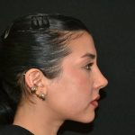 Rhinoplasty Before & After Patient #19536