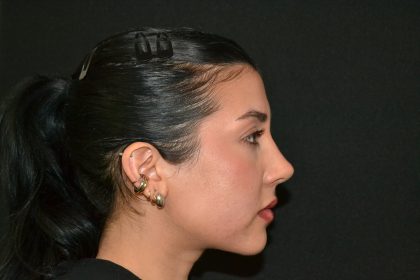 Rhinoplasty Before & After Patient #19536
