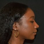 Rhinoplasty Before & After Patient #19557