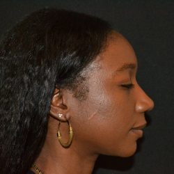 Rhinoplasty Before & After Patient #19557