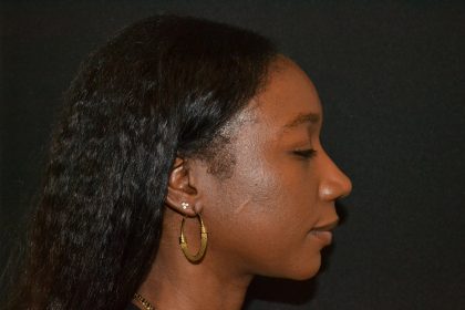 Rhinoplasty Before & After Patient #19557