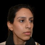 Rhinoplasty Before & After Patient #19535