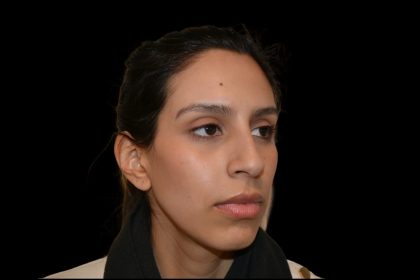 Rhinoplasty Before & After Patient #19535