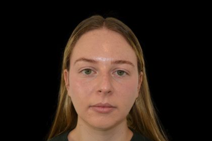 Rhinoplasty Before & After Patient #19537