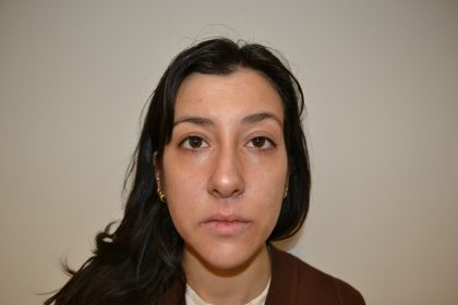 Rhinoplasty Before & After Patient #19536
