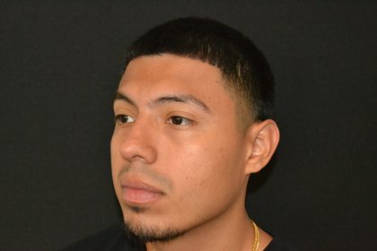 Rhinoplasty Before & After Patient #19509
