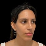 Rhinoplasty Before & After Patient #19535