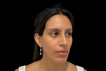 Rhinoplasty Before & After Patient #19535