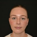 Rhinoplasty Before & After Patient #19537