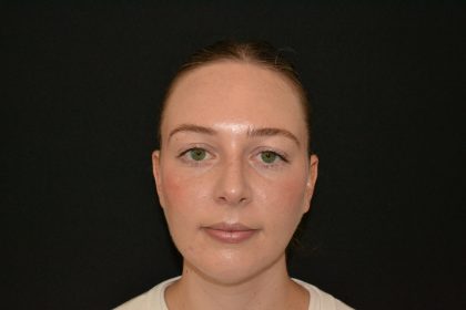 Rhinoplasty Before & After Patient #19537
