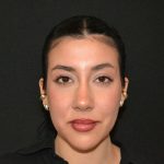 Rhinoplasty Before & After Patient #19536