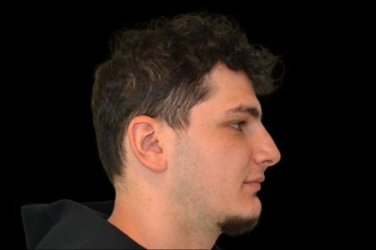 Rhinoplasty Before & After Patient #19508