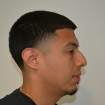 Rhinoplasty Before & After Patient #19509