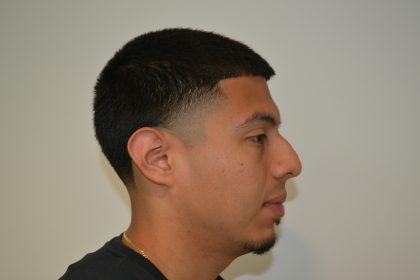 Rhinoplasty Before & After Patient #19509