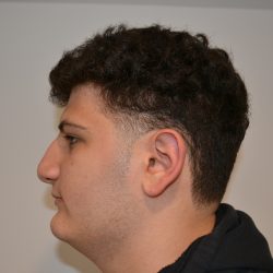 Rhinoplasty Before & After Patient #19506