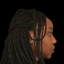 Rhinoplasty Before & After Patient #19528