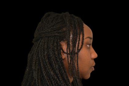 Rhinoplasty Before & After Patient #19528