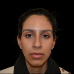 Rhinoplasty Before & After Patient #19535