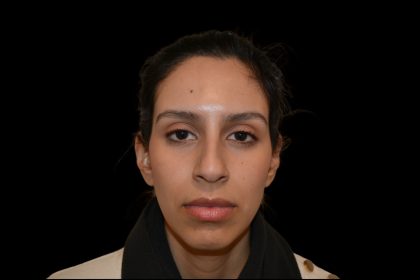 Rhinoplasty Before & After Patient #19535