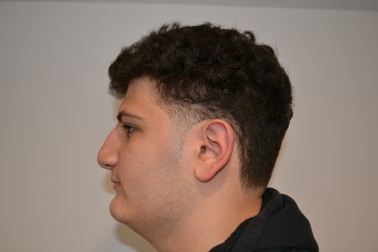 Rhinoplasty Before & After Patient #19506