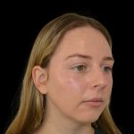 Rhinoplasty Before & After Patient #19537