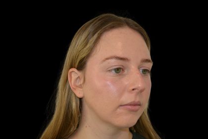 Rhinoplasty Before & After Patient #19537