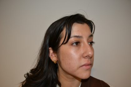 Rhinoplasty Before & After Patient #19536