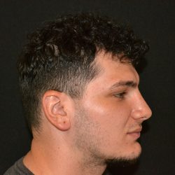Rhinoplasty Before & After Patient #19508