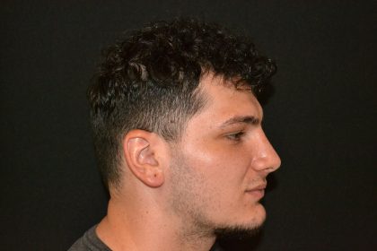 Rhinoplasty Before & After Patient #19508