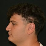Rhinoplasty Before & After Patient #19506