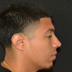 Rhinoplasty Before & After Patient #19509