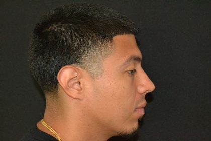Rhinoplasty Before & After Patient #19509
