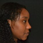 Rhinoplasty Before & After Patient #19528