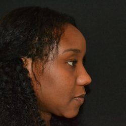Rhinoplasty Before & After Patient #19528