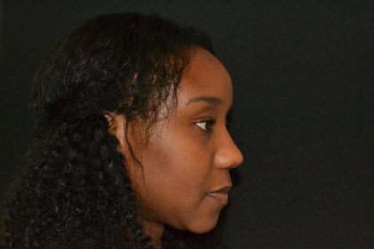 Rhinoplasty Before & After Patient #19528