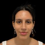 Rhinoplasty Before & After Patient #19535