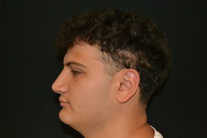 Rhinoplasty Before & After Patient #19506