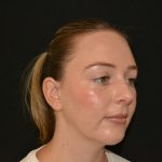 Rhinoplasty Before & After Patient #19537