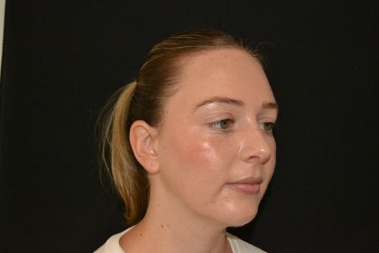 Rhinoplasty Before & After Patient #19537