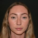 Rhinoplasty Before & After Patient #19627
