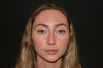 Rhinoplasty Before & After Patient #19627